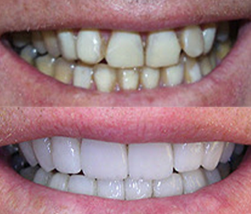 Teeth Whitening in Pittsford, NY | Village Smiles Family Dentistry